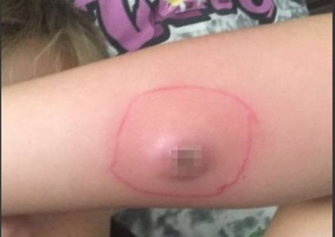 Criança é picada por aranha e deixa buraco horrível no braço