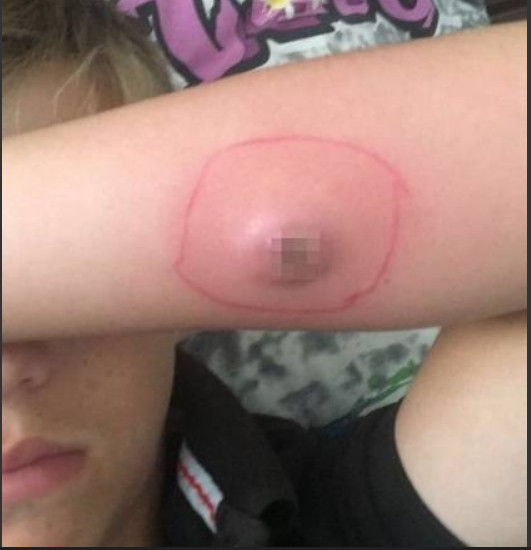 Criança é picada por aranha e deixa buraco horrível no braço