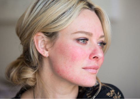 Vermelhidão e pele do rosto irritada? Cuidado, pode ser rosácea