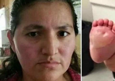 Babá se irrita com bebê de 6 meses e queima seus pés em frigideira quente