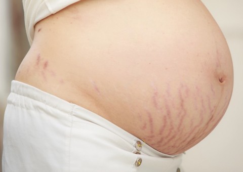 Conheça o tratamento caseiro que vai eliminar de vez as indesejáveis estrias 