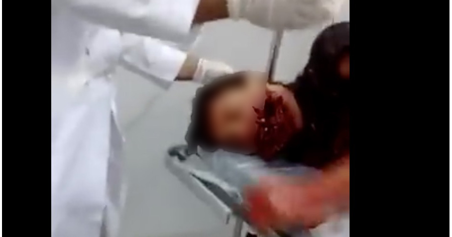 Jovem tem rosto esfacelado e morre após celular explodir durante ligação 