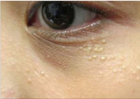 Saiba como acabar de vez com milias, bolinhas que surgem ao redor dos olhos