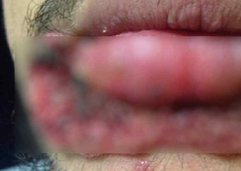 Alerta: Homem 'cutuca' espinha no rosto e o pior acontece