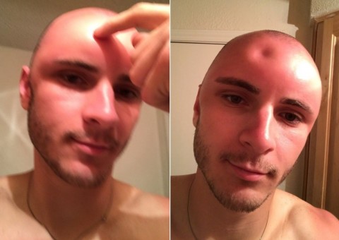 Jovem choca com testa amassada e foto viraliza na web