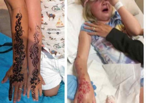 ALERTA: Tatuagem de hena provoca queimaduras graves em menina de 7 anos