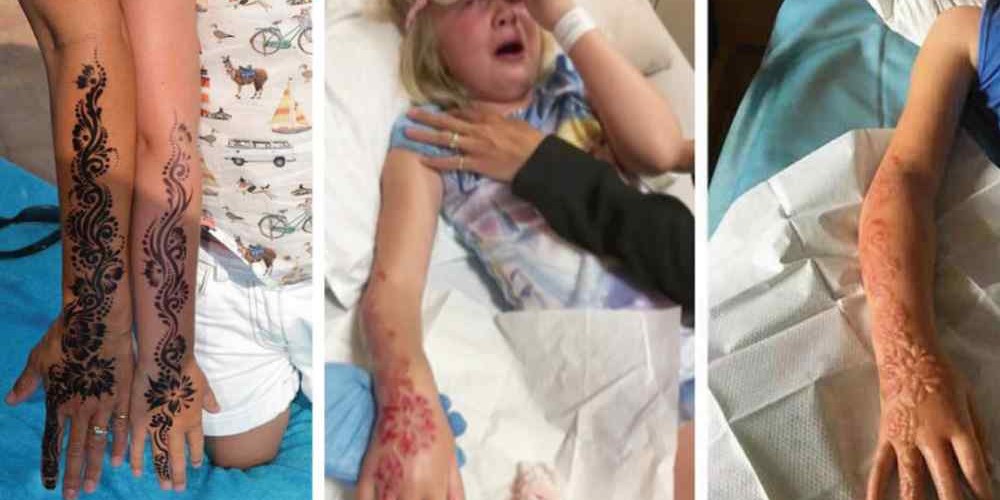 ALERTA: Tatuagem de hena provoca queimaduras graves em menina de 7 anos
