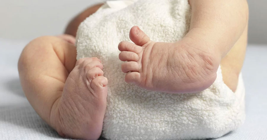 Susam pretende zerar fila de tratamento do Pé Torto Congênito