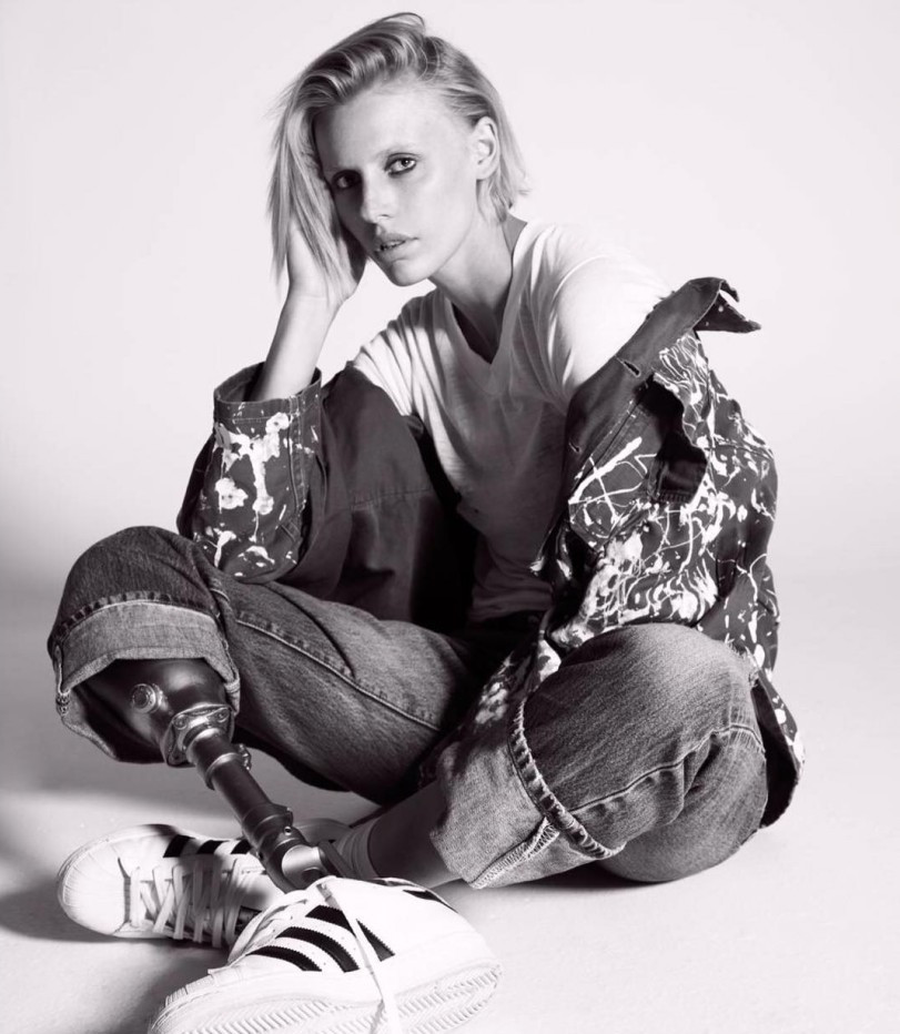 Modelo que teve perna amputada por causa de absorvente pode perder outra