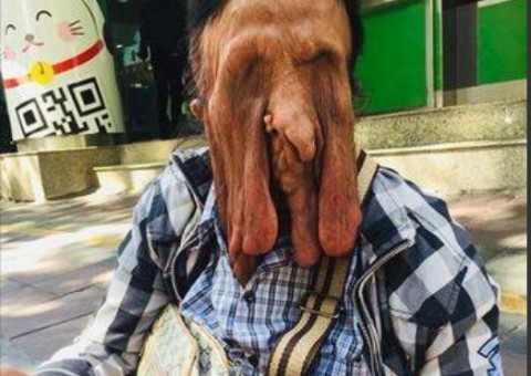 Mulher com doença rara sofre com rosto 'derretido'