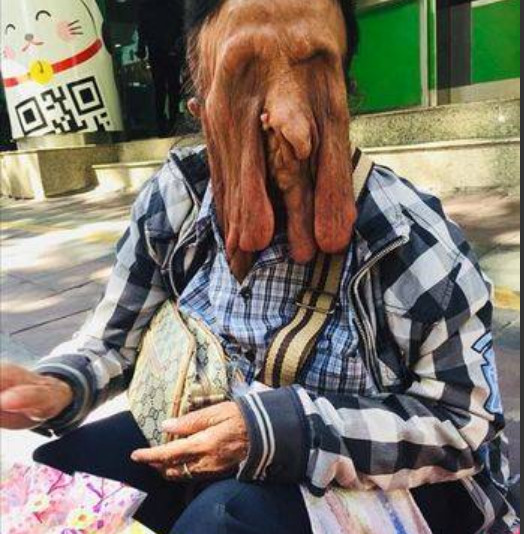 Mulher com doença rara sofre com rosto 'derretido'