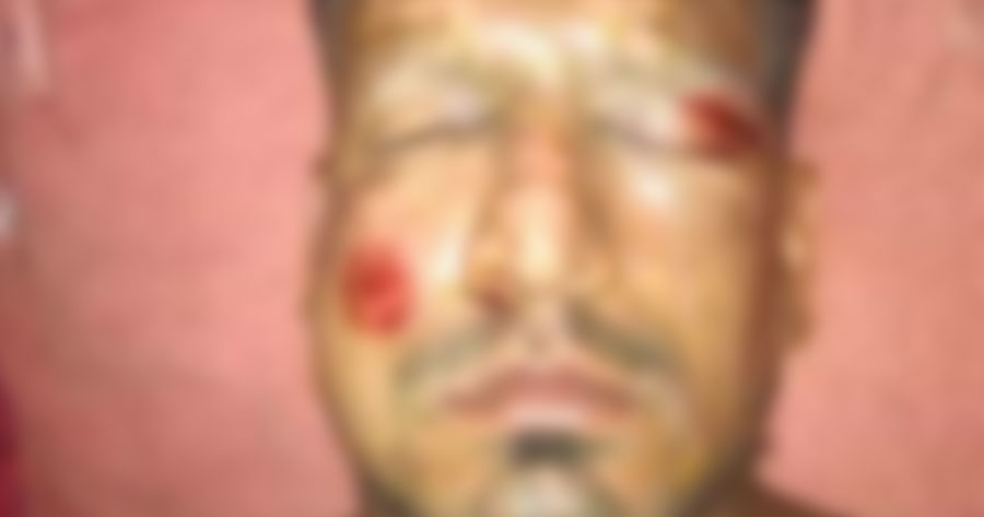 Jogador do Peñarol tem rosto desfigurado após ser atingido por fogo de artifício