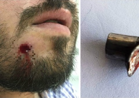 Homem leva tiro no rosto e retira bala com as próprias mãos
