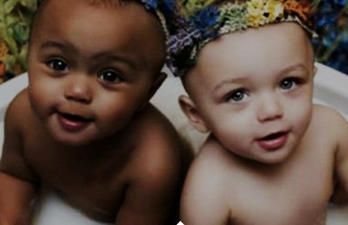 Primeiras gêmeas do mundo com cores de pele diferentes já são adultas; Veja