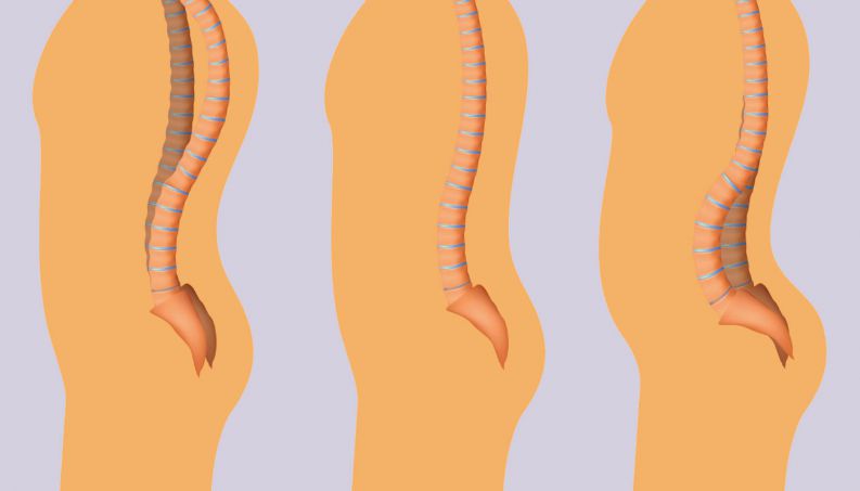 Endometriose, infecções e mais doenças e lesões que podem causar dor na lombar