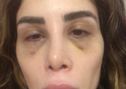 Youtuber Camila Uckers mostra corpo deformado após complicação com prótese de silicone 