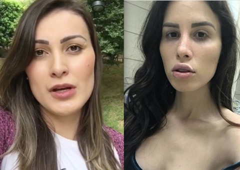 Irreconhecível, youtuber que sofreu infecção por silicone recebe ligação de Andressa Urach
