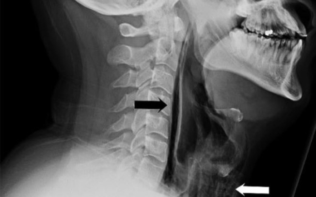 Homem tem garganta rompida depois de tentar segurar um espirro