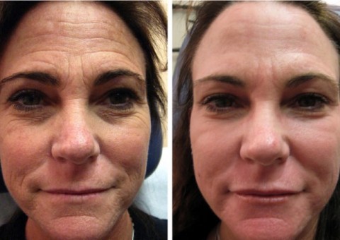 Combata a flacidez facial com 5 poderosos remédios caseiros  