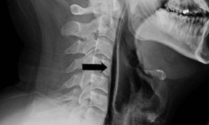 Homem sofre fratura grave na garganta após prender espirro