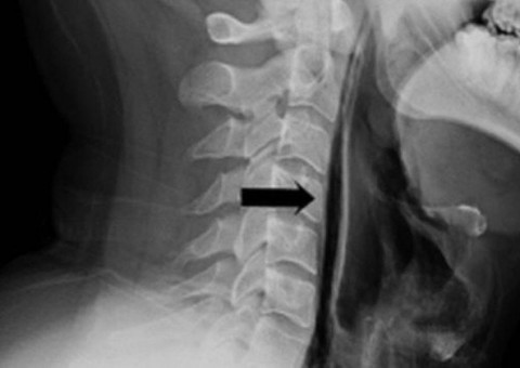 Homem sofre fratura grave na garganta após prender espirro