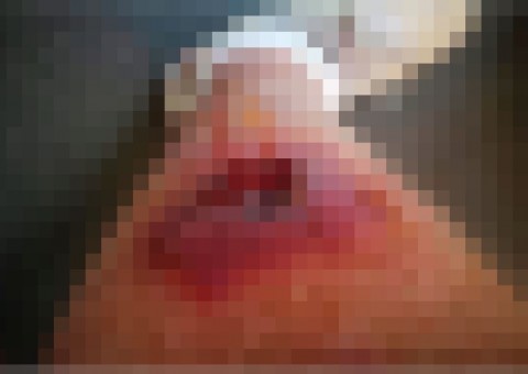  Picada de aranha deixa buraco do tamanho de uma laranja na perna de homem