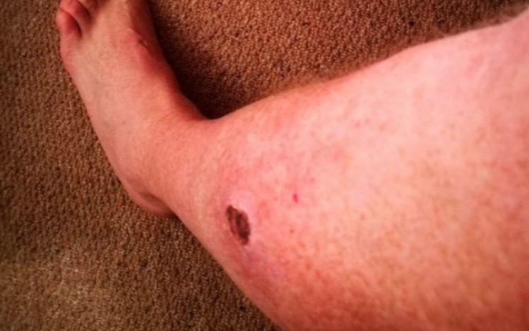  Picada de aranha deixa buraco do tamanho de uma laranja na perna de homem