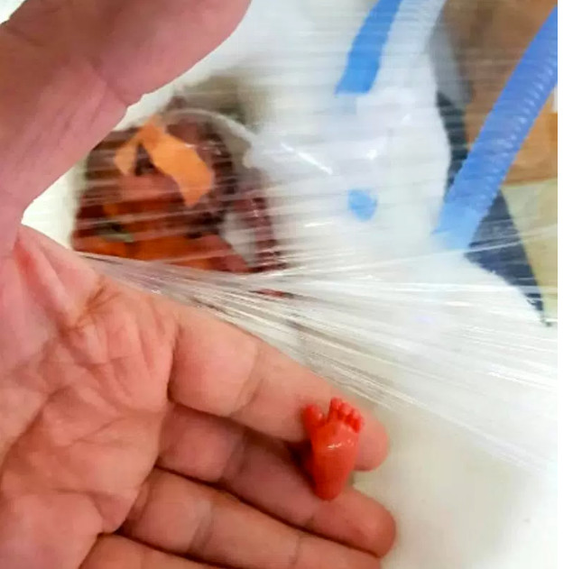 Bebê nasce pesando menos de 400 gramas e surpreende médicos