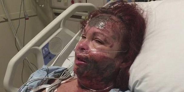 Mulher que teve rosto desfigurado com ácido em suposto ataque revela mentira