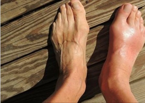 Elimine a gota e o ácido úrico definitivamente com um único ingrediente