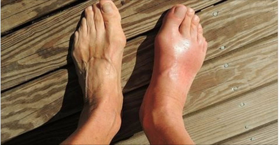 Elimine a gota e o ácido úrico definitivamente com um único ingrediente