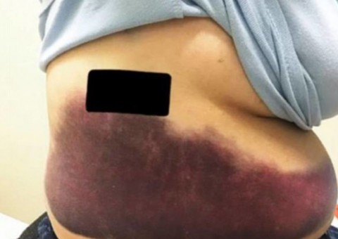Mulher com coqueluche quebra costela após crise de tosse