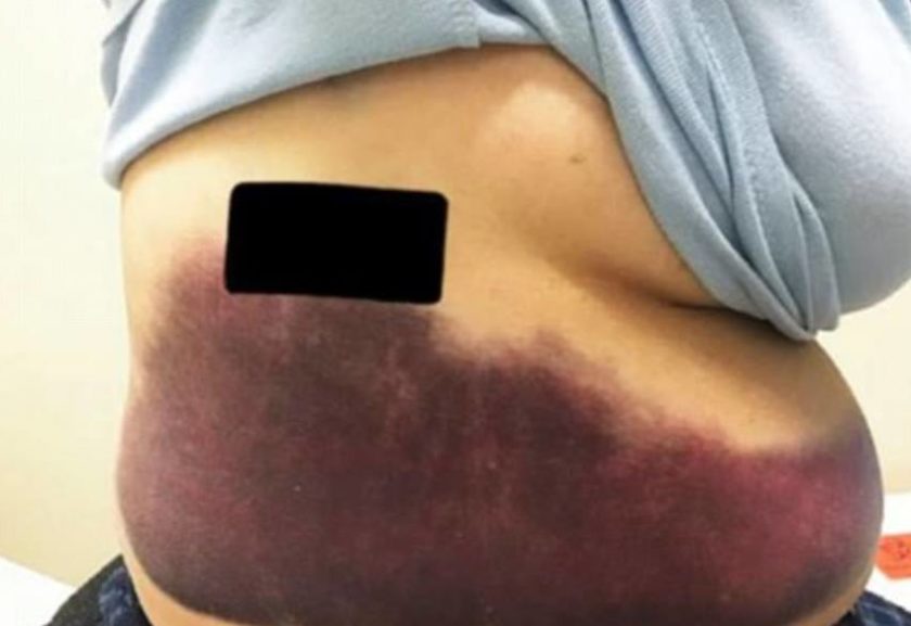 Mulher com coqueluche quebra costela após crise de tosse