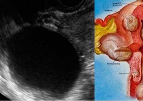 Para destruir mioma e cistos no ovário, basta tomar essa bebida 