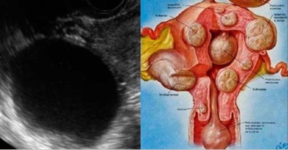 Para destruir mioma e cistos no ovário, basta tomar essa bebida 