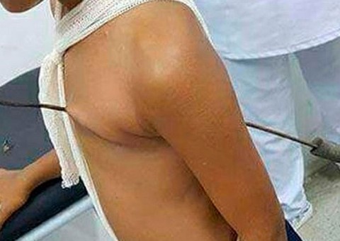 Menino tem espeto atravessado no coração e milagre acontece