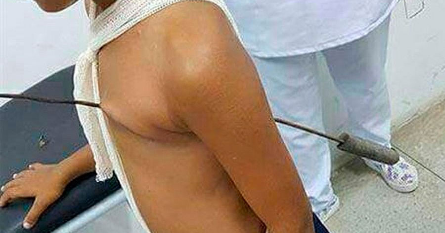 Menino tem espeto atravessado no coração e milagre acontece