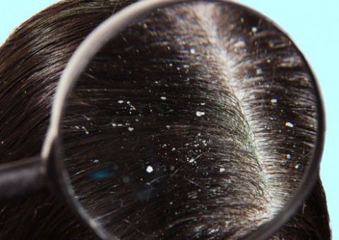 O que você JAMAIS deve fazer quando tem casquinhas no couro cabeludo após progressiva