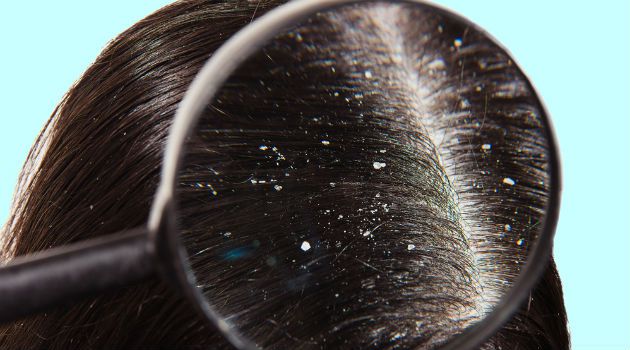 O que você JAMAIS deve fazer quando tem casquinhas no couro cabeludo após progressiva