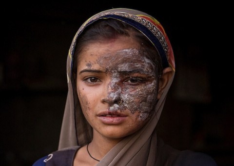 Jovem vítima de ataque de ácido causado pelo próprio pai compartilha resultado de cirurgia 