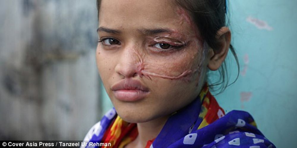 Jovem vítima de ataque de ácido causado pelo próprio pai compartilha resultado de cirurgia 