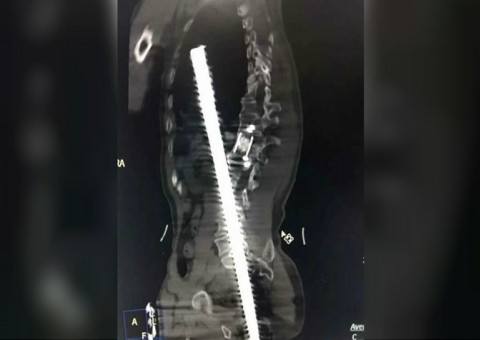 Barra de aço atravessa corpo de homem e milagre acontece