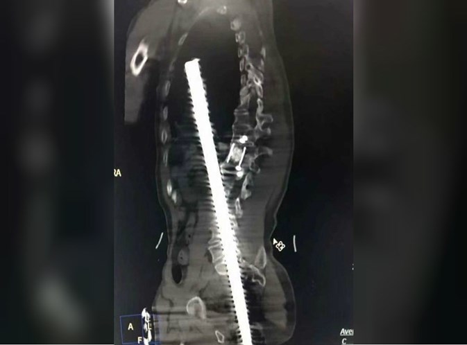 Barra de aço atravessa corpo de homem e milagre acontece