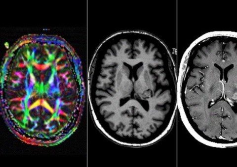 Mulher que dizia 'ouvir a voz de Deus' descobre tumor cerebral que gera delírios