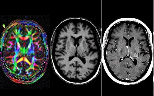 Mulher que dizia 'ouvir a voz de Deus' descobre tumor cerebral que gera delírios