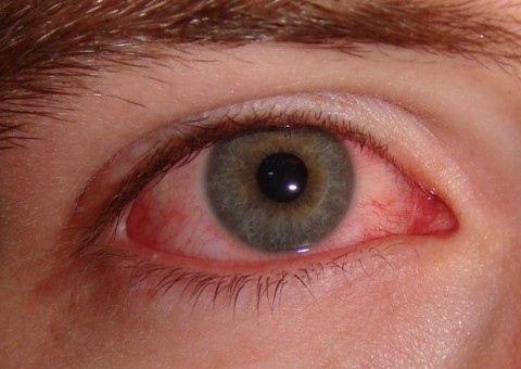 Saiba o que é herpes zóster nos olhos e porque ela é comum nessa época do ano