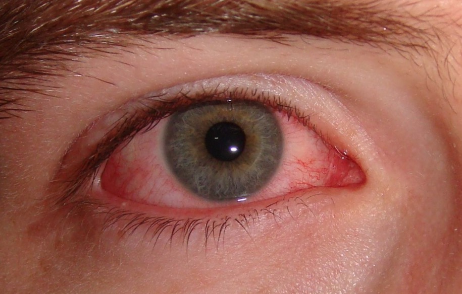Saiba o que é herpes zóster nos olhos e porque ela é comum nessa época do ano