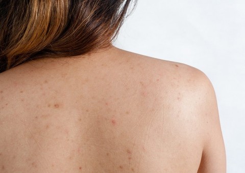 Médica ensina 2 cuidados simples que evitam surgimento de espinhas nas costas