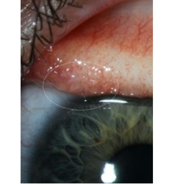 Mulher sente enxaqueca e encontra 14 vermes em seu olho