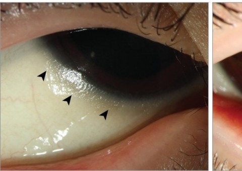 Garoto de 11 anos fica cego após fazer dieta restritiva 